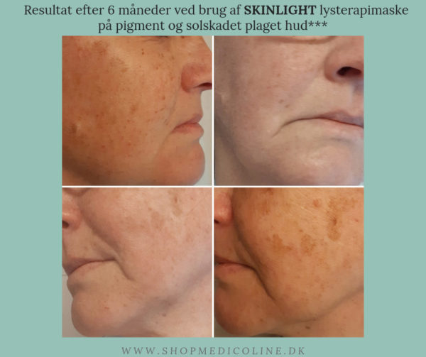 SKINLIGHT Light therapy mask before and after